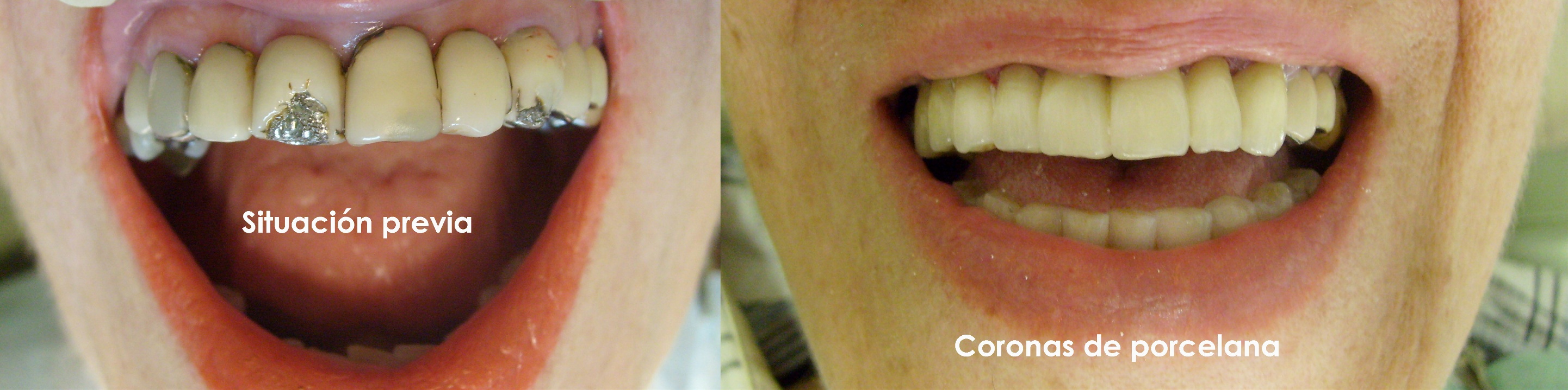 Prótesis sobre dientes