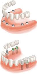 Prótesis sobre implantes