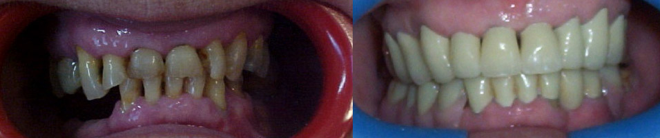 Rehabilitación oral